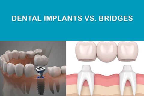 Dental Implants vs. Bridges: Which Is Best for You? | Phillips Ranch